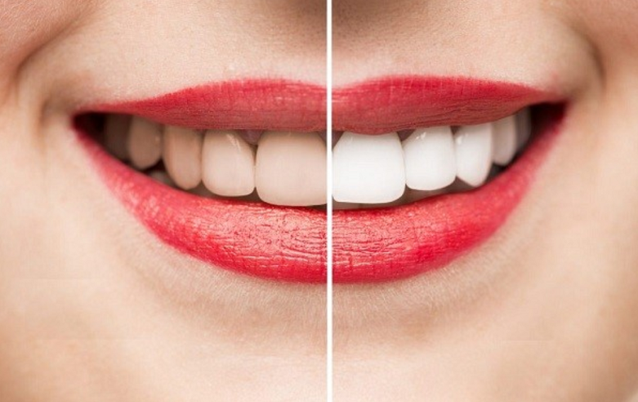 Ưu điểm của tẩy trắng răng tại nha khoa