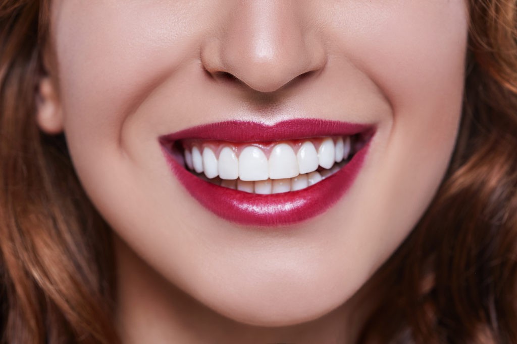 Quy trình dán sứ veneer: Đơn giản và ít phải mài hơn làm răng sứ, nhưng cũng “khó nhằn” ra phết