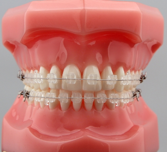 9 điều bạn cần biết về bọc răng sứ Thực sự có bao nhiêu loại răng sứ