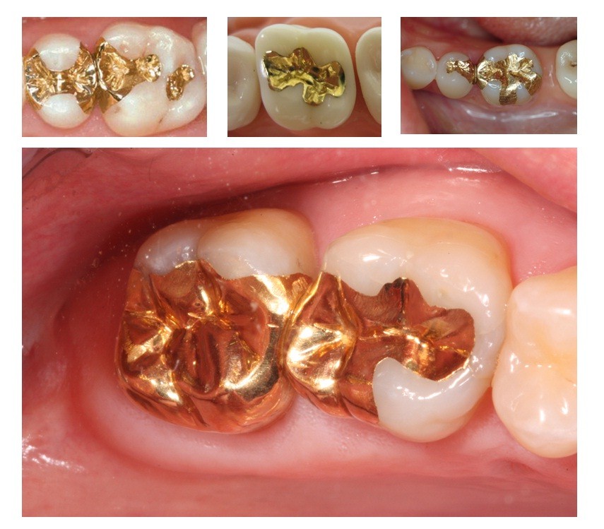 Trám răng bằng vàng và kim loại quý