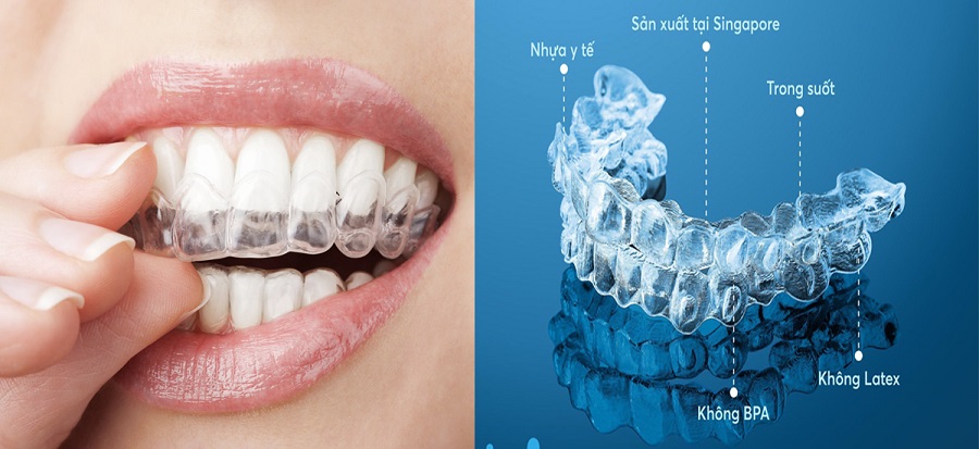 Niềng răng trong suốt See through Aligner