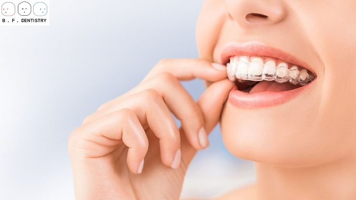 Chi phí niềng răng thẩm mỹ có đắt không?