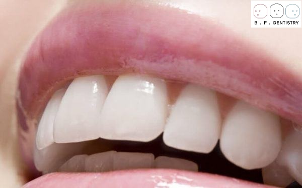 Làm sao để răng hết vẩu vĩnh viễn?
