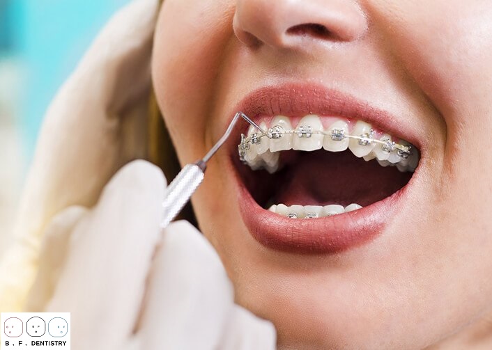 Sau khi đã bọc răng sứ, để bắt đầu cho quá trình niềng răng thì bác sĩ sẽ gắn các mắc cài lên răng sứ