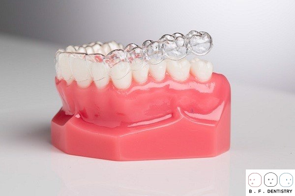 Nếu bạn đã từng bọc răng sứ thì niềng răng trong suốt Invisalign là vô cùng thích hợp.