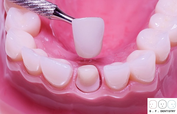 Bọc răng sứ là một trong những phương pháp phục hình răng miệng hiện đại mà được nhiều bệnh nhân cũng như bác sĩ lựa chọn.