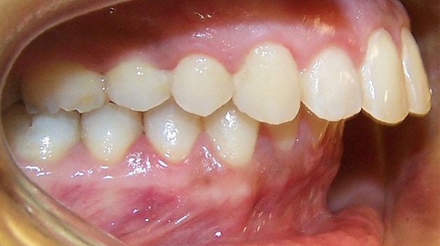 Vẩu dpo cả răng và xương hàm