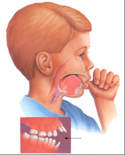 Các loại răng vẩu thường gặp và cách xử lý