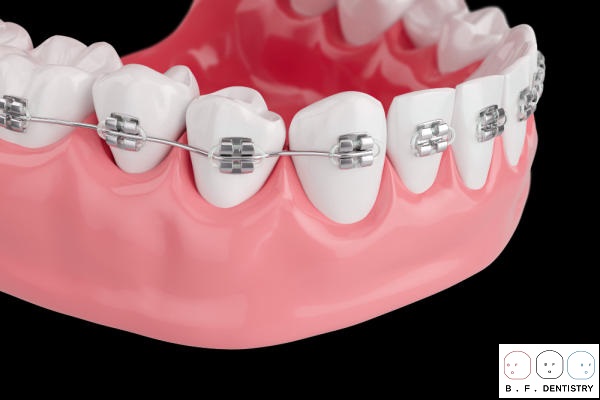 iềng răng sẽ giúp khắc phục những khuyết điểm liên quan đến cấu trúc răng như răng lệch lạc, khấp khểnh, thưa,…