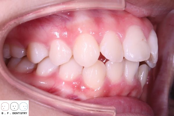 Niềng răng có thể khắc phục được khuyết điểm khi hàm bị hô mà bọc răng sứ đơn lẻ không khắc phục được 