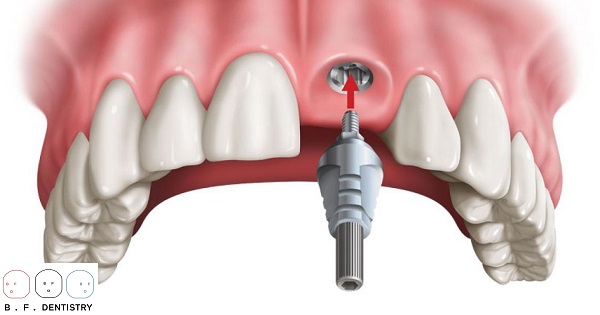 Trồng răng implant cho răng cửa