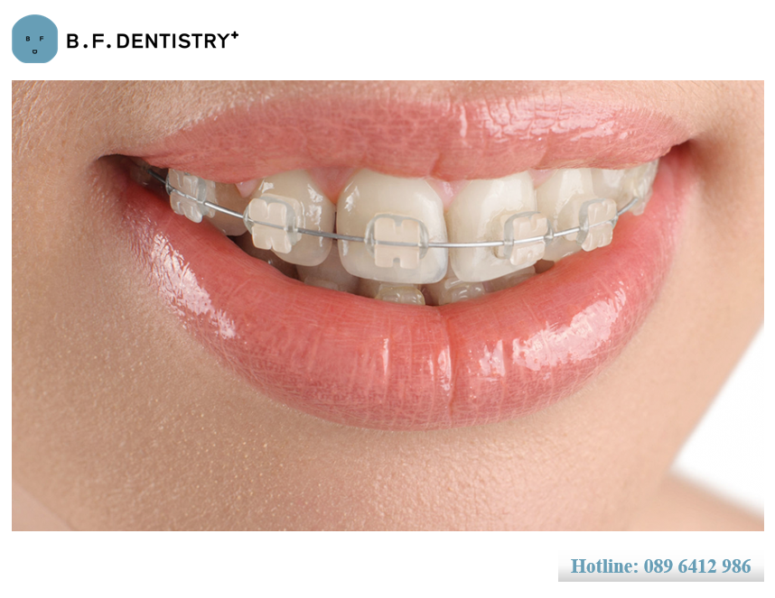 Niềng răng là giải pháp khôi phục thẩm mỹ để giúp bạn sở hữu một nụ cười hoàn hảo và tự tin