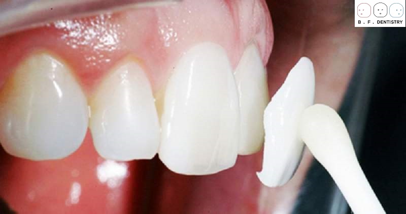 Cách làm hết răng cửa dài?