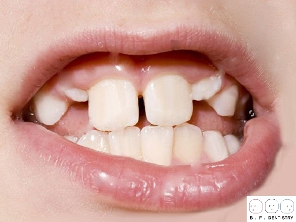 Cách chỉnh răng thưa ở trẻ em?