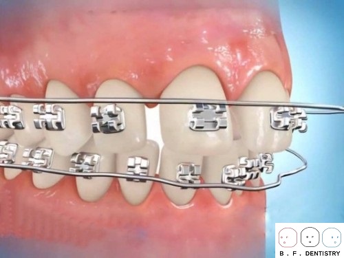 Cơ chế niềng răng sẽ hoạt động dựa trên lực kéo của các khí cụ chỉnh nha.