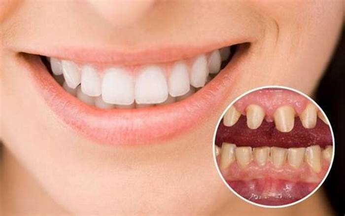 Phương pháp bọc răng sứ không những có thể chỉnh hình răng mà còn làm răng bạn trở nên trắng sáng hơn