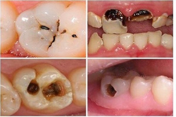 Tình trạng sâu răng rất nhiều thế nhưng việc bị tích tụ các mảng bám cũng khá phổ biến.