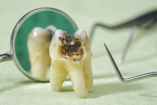 Đây là hiện tượng mô răng sẽ bị phá hoại do các chất nằm trong thức ăn.