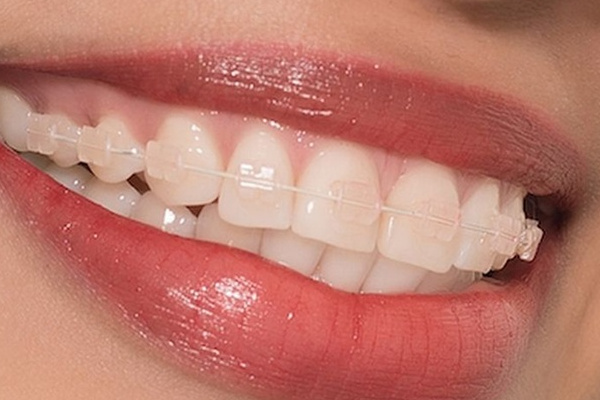 Chất liệu bằng sứ sẽ có màu giống như trên răng thật của bạn.
