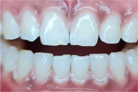Với công nghệ này thì sẽ đem lại cho bạn một hàm răng trắng sáng, đều đẹp.