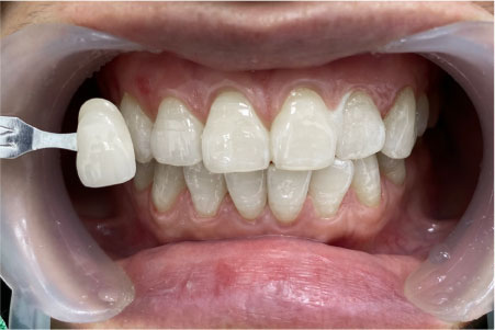 Phủ răng sứ Veneer đã đem lại cho chúng ta những lợi ích toàn diện về mọi mặtPhủ răng sứ Veneer đã đem lại cho chúng ta những lợi ích toàn diện về mọi mặt
