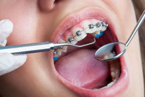 Đây là một kỹ thuật chỉnh sửa răng miệng nhằm mục đích tạo cho bạn một hàm răng đẹp hơn.