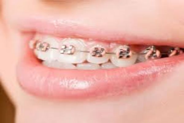 Thời gian niềng răng bằng mắc cài kim loại sẽ kéo dài trung bình từ 1 – 3 năm