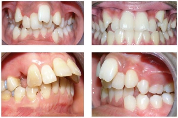 Răng mọc lệch lạc là một vấn đề về răng có thể được xem là nghiêm trọng do các biến chứng của nó đến sức khỏe.