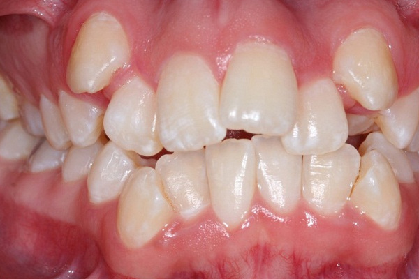 Răng mọc lệch lạc là một vấn đề mà có thể dẫn tới các biến chứng rất nghiêm trọng