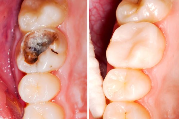 Đối với trường hợp tệ nhất bạn có thể buộc phải nhổ đi chiếc răng bị sâu. Bên cạnh đó một số mức độ răng bị sâu đến nổi bạn không thể gán mắc cài