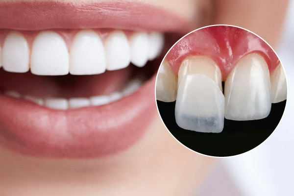 Mặt dán sứ Veneer là một loại sứ mặt mỏng và được cố định lên bề mặt ngoài của răng thật.