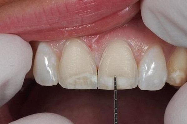 công nghệ dán sứ đã ra đời sẽ giúp bạn hạn chế tối đa việc mài răng.