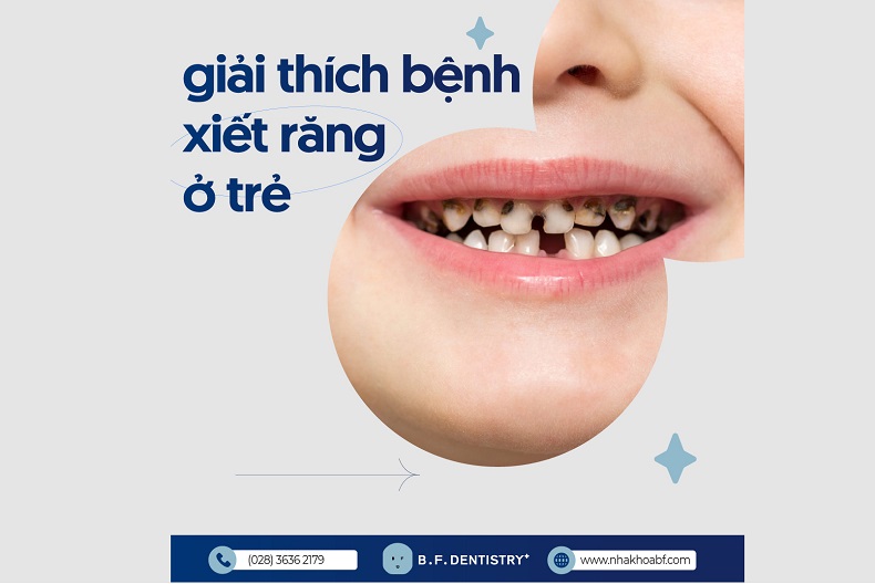 xiết ăn răng ở trẻ