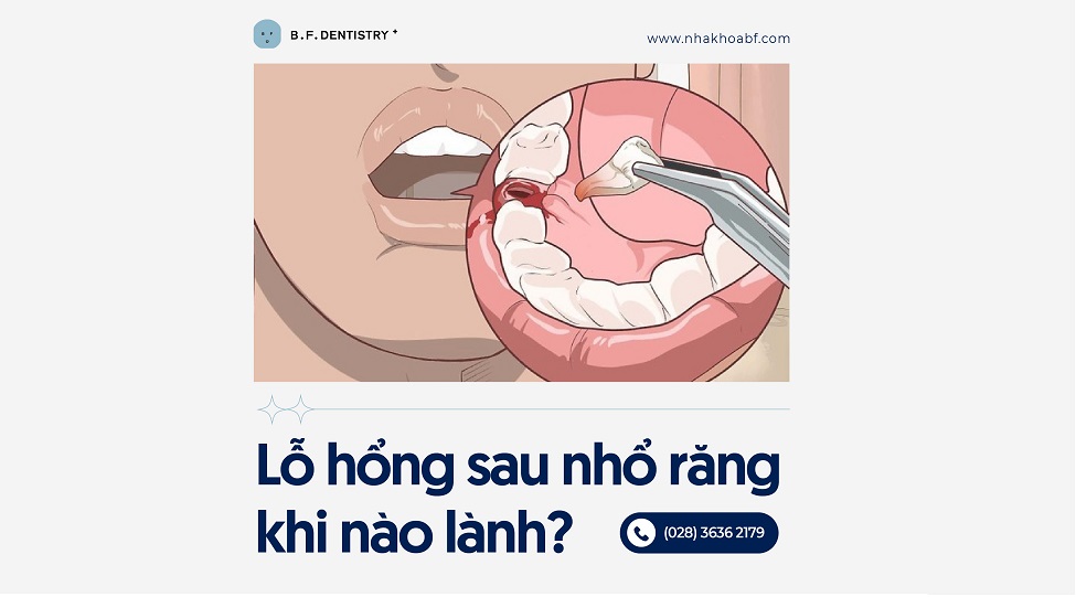 Lỗ hỏng sau nhổ răng khi nào lành?