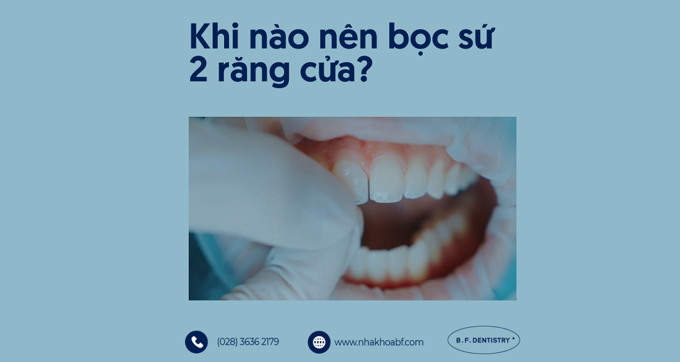 Trường hợp nên bọc sứ 2 răng cửa