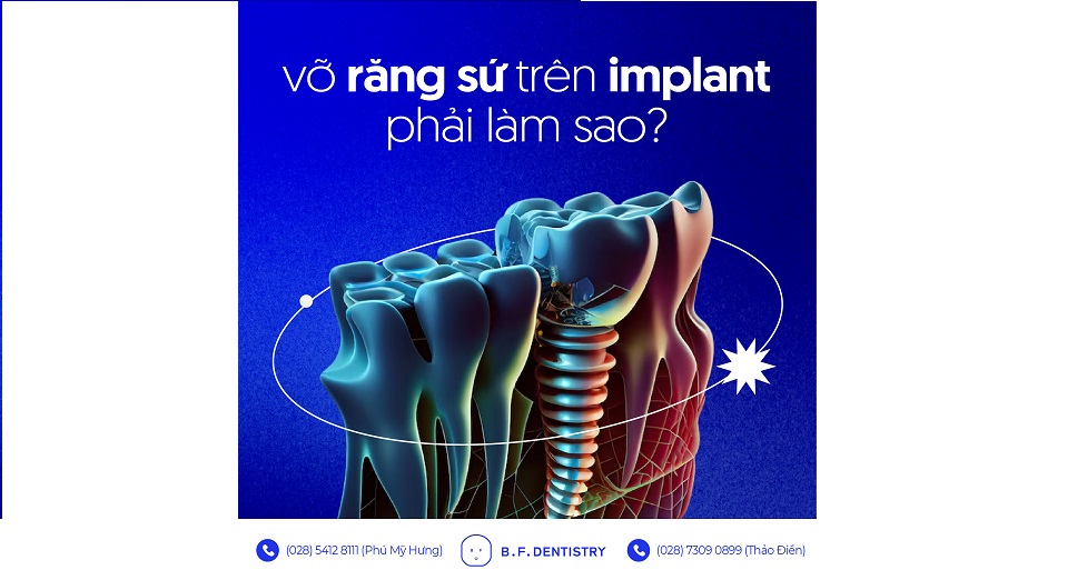 Vỡ răng sứ trên Implant phải làm sao?